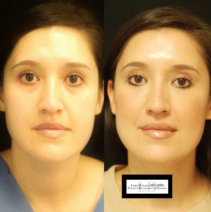 dr lara devgan eye cream