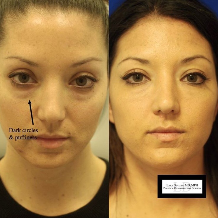 dr lara devgan eye cream