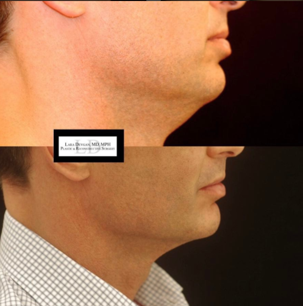 Male patient with excess under-chin skin.