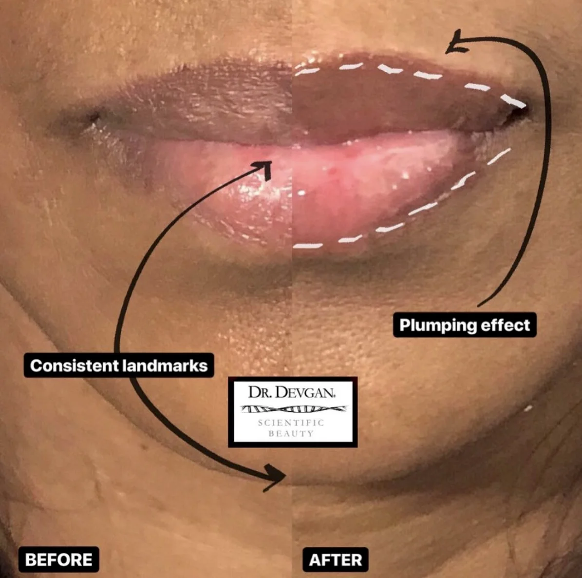 Improved coloring of the lips after a few minutes.