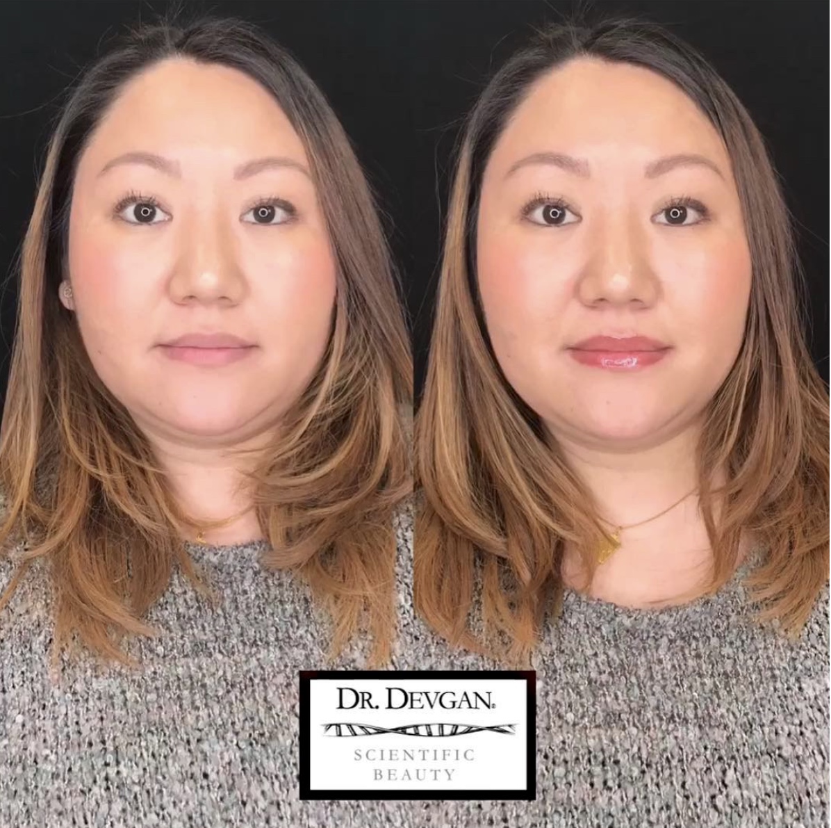 Platinum Lip Plump before and after pictures.