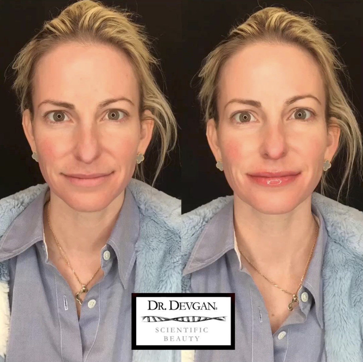Platinum Lip Plump before and after pictures.