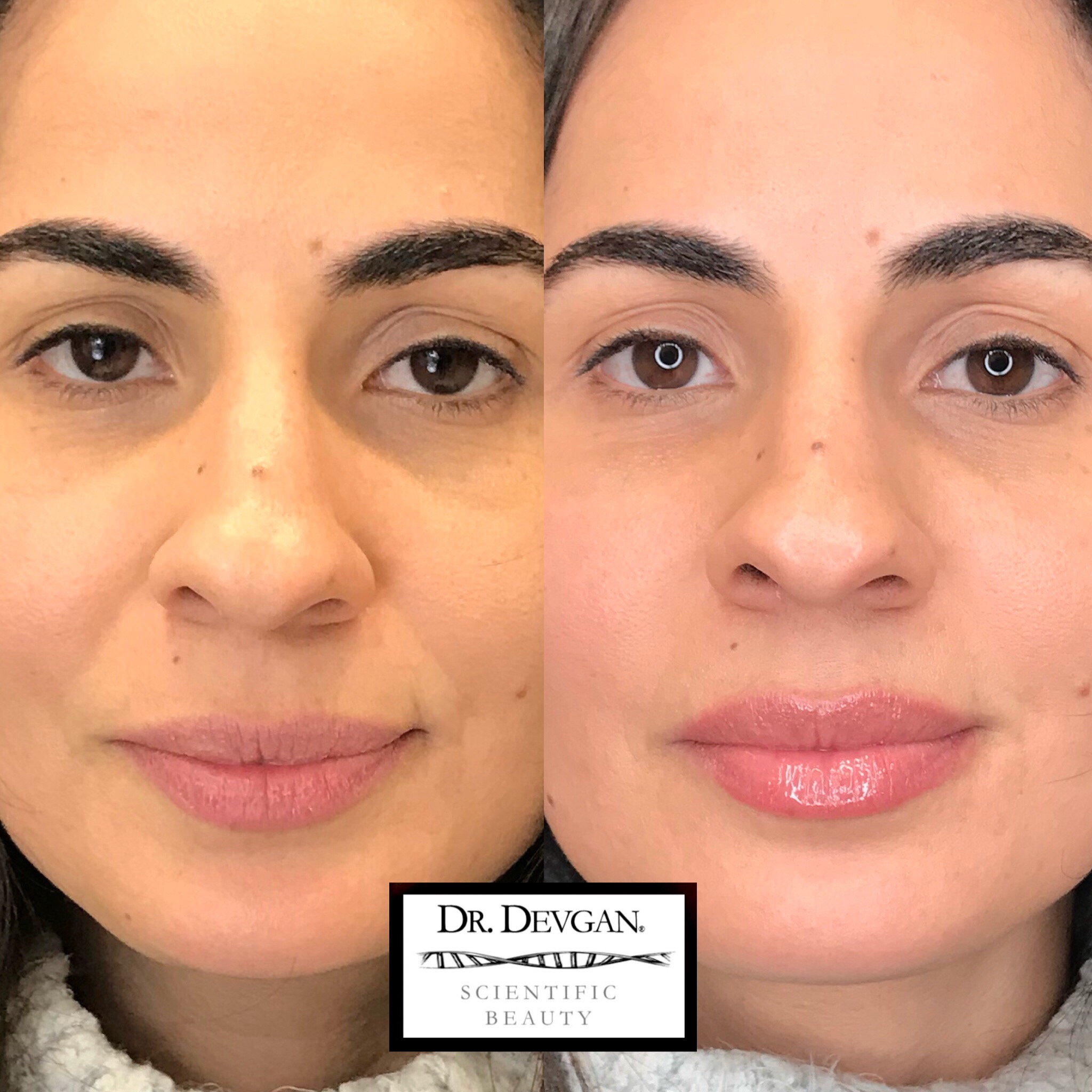 Before and after photos of a beautiful client using Platinum Lip Plump