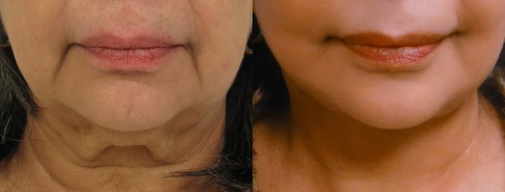 Actual patient of Dr. Devgan, ethnicity: Middle Eastern. Before & 2 months after facelift