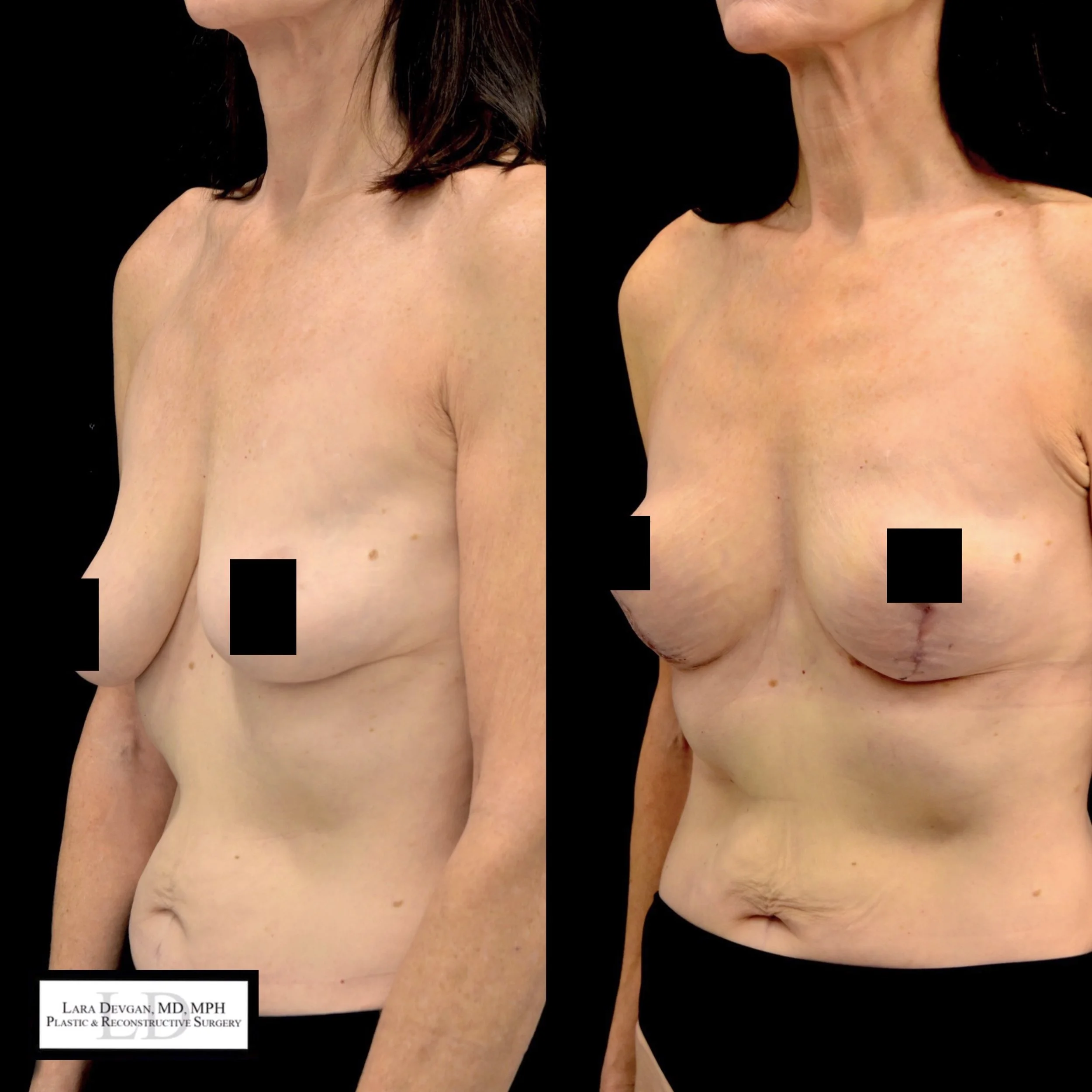 Actual patient of Dr. Devgan, who is in her 60s, before and 6 weeks after breast lift (mastopexy). Scars are immature and will fade to nearly invisible by 1 year.