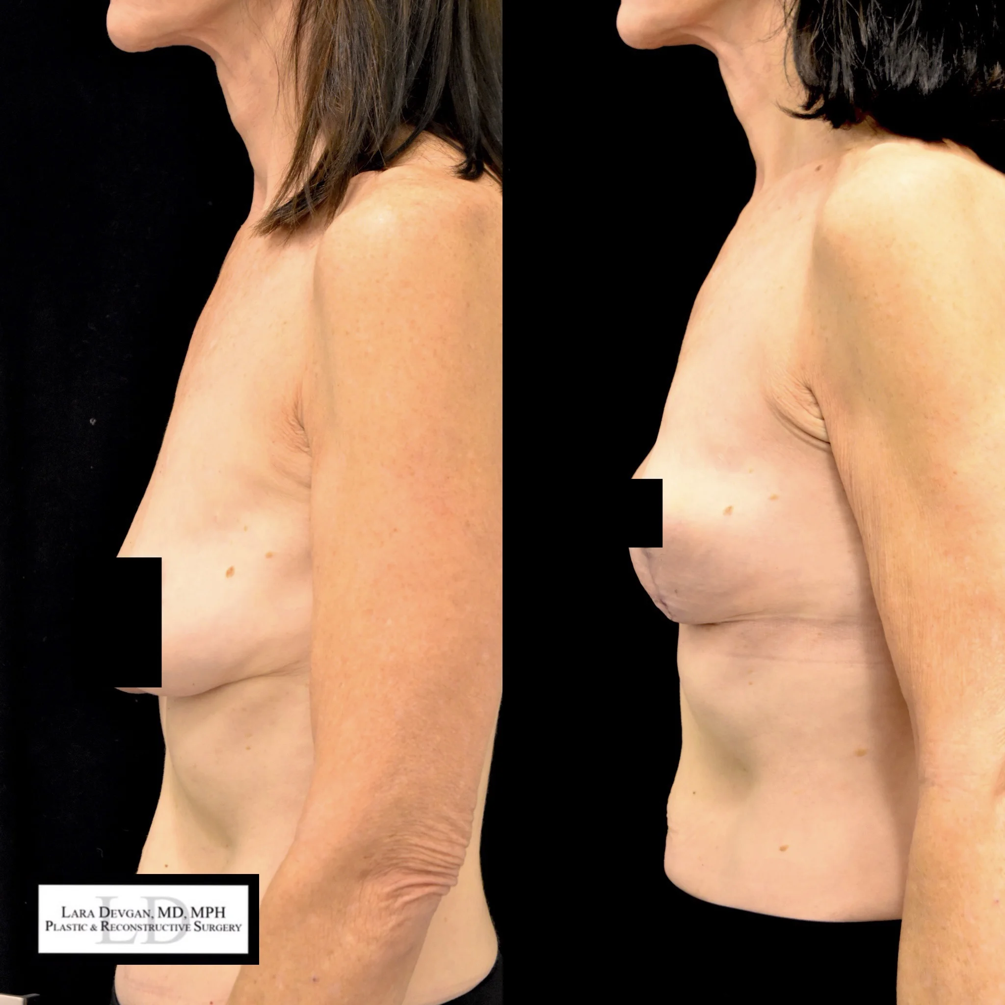 Actual patient of Dr. Devgan, who is in her 60s, before and 6 weeks after breast lift (mastopexy). Scars are immature and will fade to nearly invisible by 1 year.