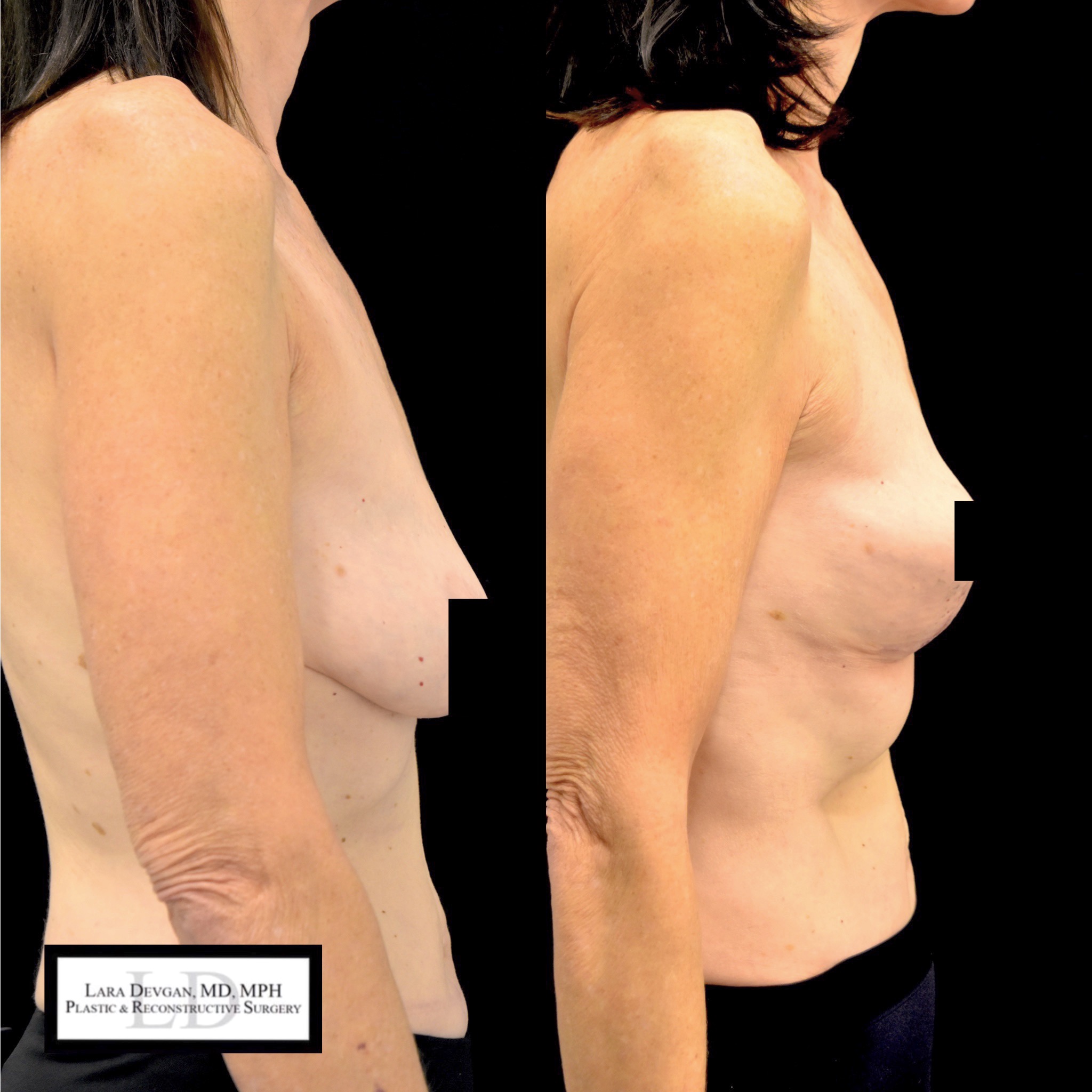 Actual patient of Dr. Devgan, who is in her 60s, before and 6 weeks after breast lift (mastopexy). Scars are immature and will fade to nearly invisible by 1 year.