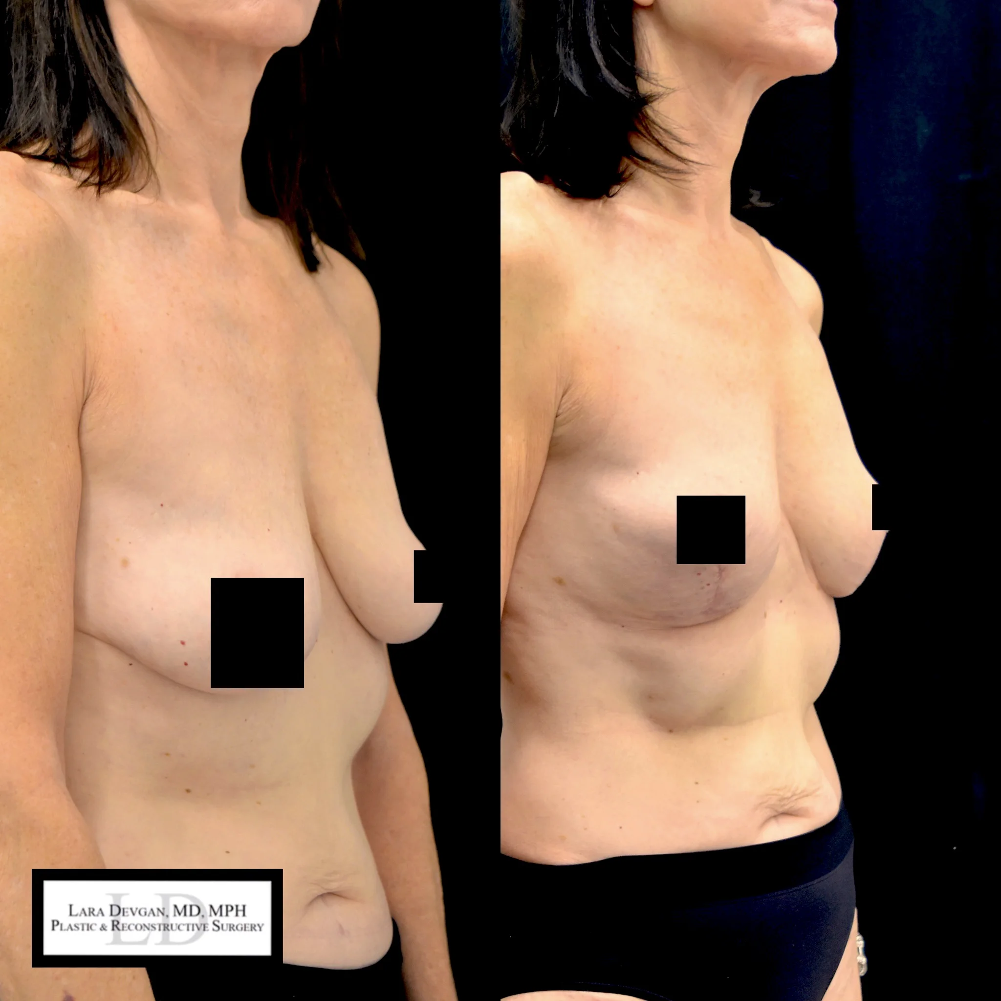 Actual patient of Dr. Devgan, who is in her 60s, before and 6 weeks after breast lift (mastopexy). Scars are immature and will fade to nearly invisible by 1 year.
