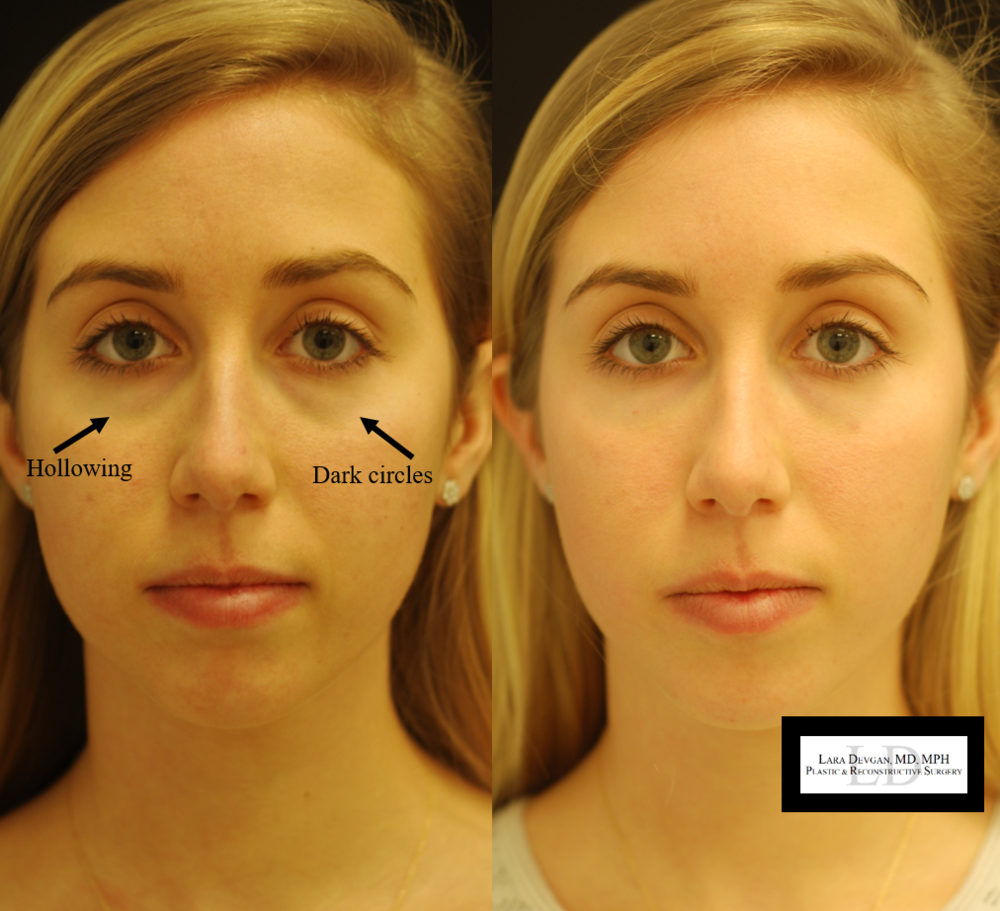 tear+trough+augmentation+nyc.png