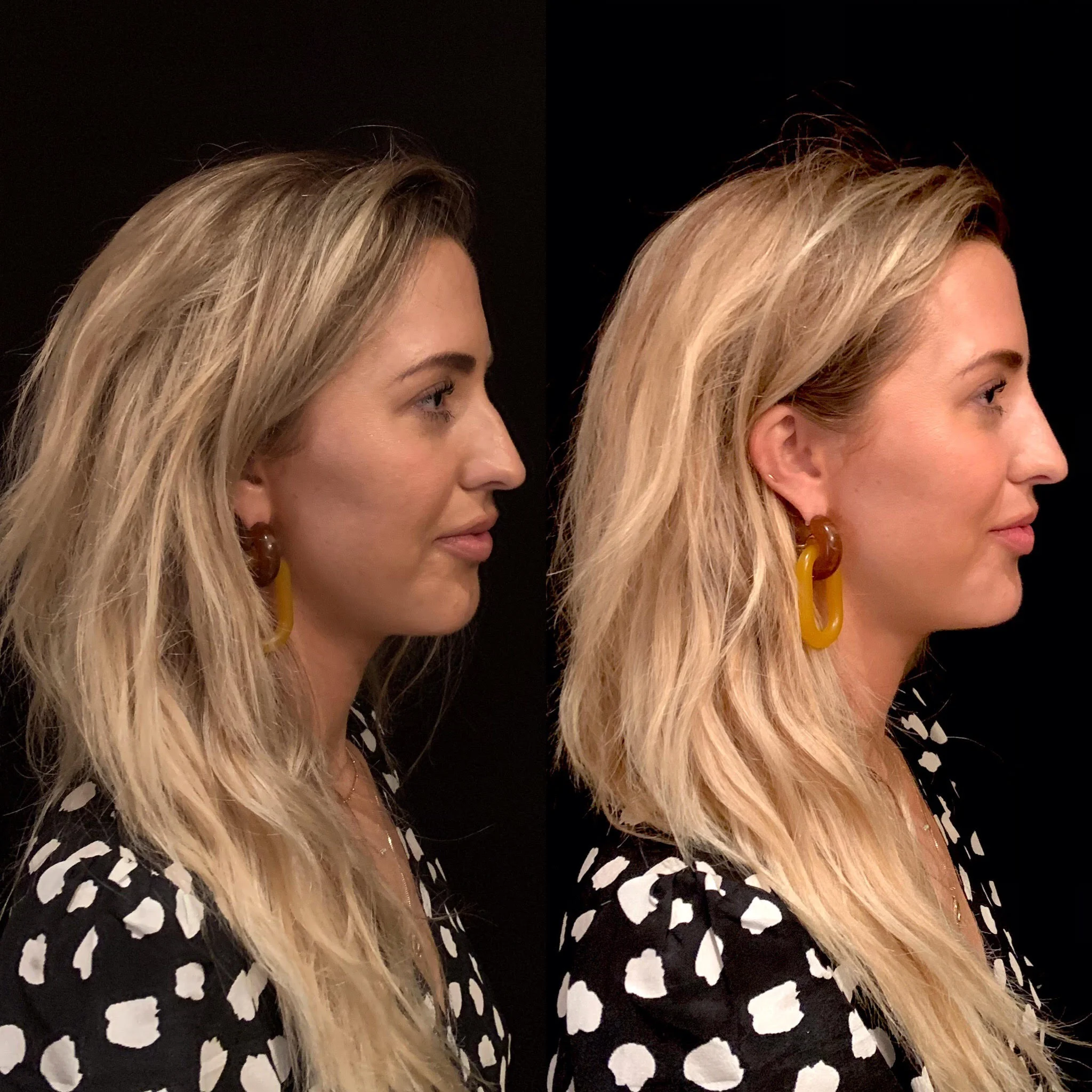 This is the Before and After for our model who received a nonsurgical rhinoplasty and chin augmentation. Directly after the procedure we are able to see instant results.