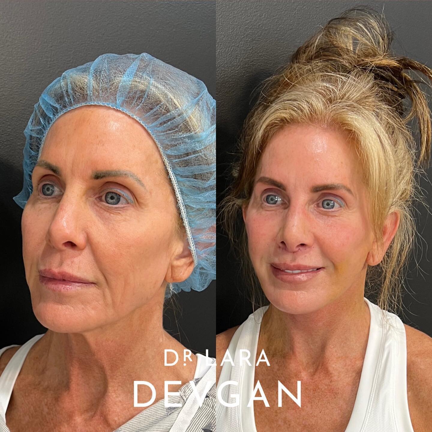 Gorgeous healing 6 days after global surgical facial optimization 📐📐📐 Midface lift, lower facelift, necklift, autologous fat grafting for eye area and mid face rejuvenating, lip lift, revision nasal surgery, and erbium laser. Her healing will keep