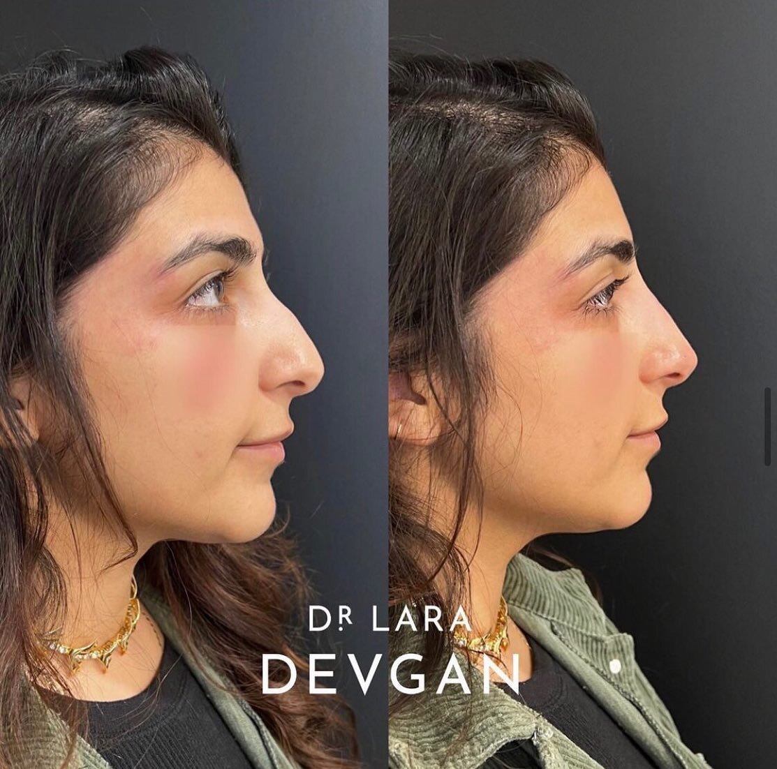 Profile balancing finesse 📐📐📐 my signature non-surgical rhinoplasty: dorsal straightening and tip refinement, as well as lift of the nasolabial angle and subtle chin augmentation with anterior projection

Many tiny changes because #beautyisinthede