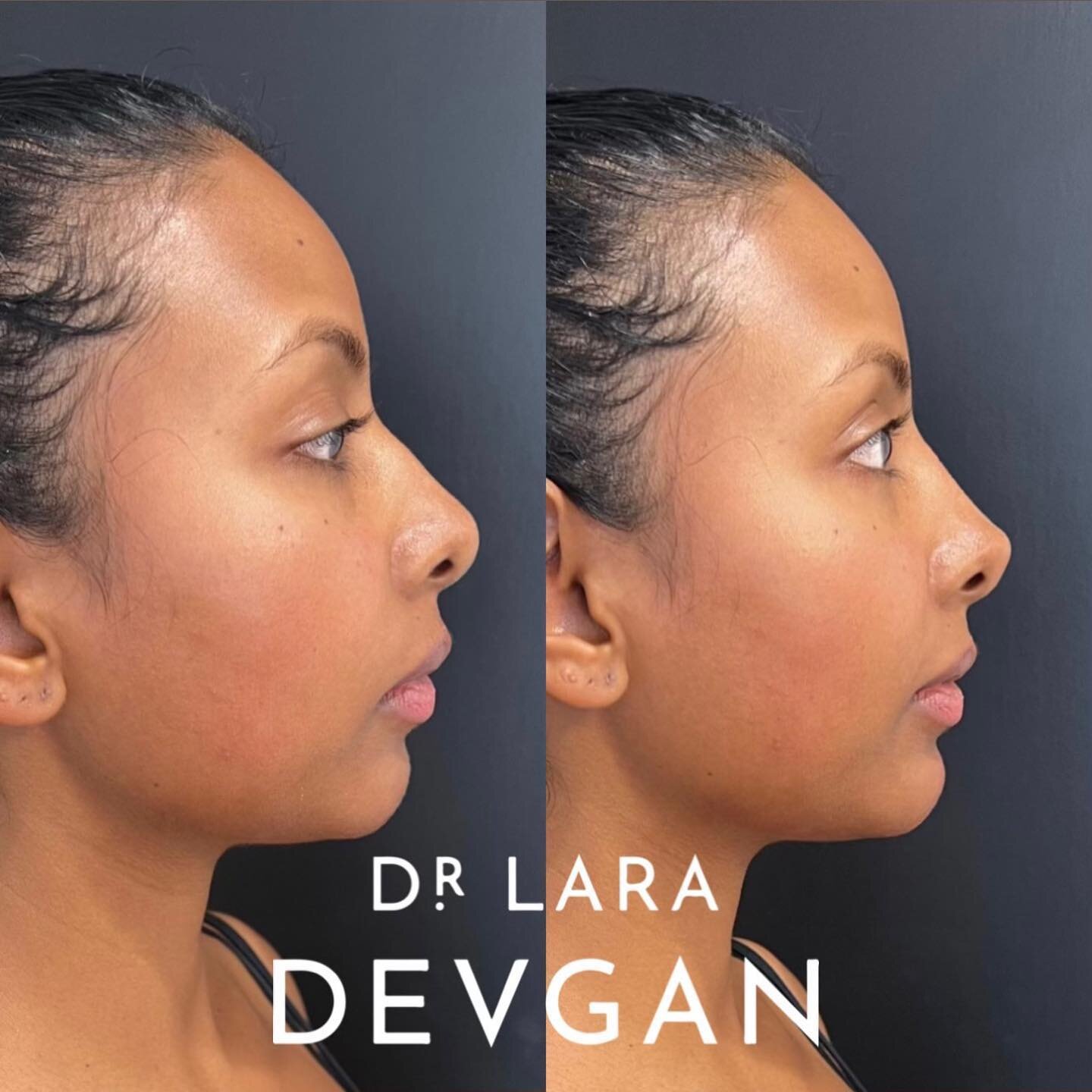Nonsurgical profile balancing 📐📐📐 My signature approach to nonsurgical rhinoplasty and chin augmentation for harmony of the features. #beautyisinthedetails #facialoptimization #boardcertifiedplasticsurgeon #devganoptimization #nonsurgicalrhinoplas