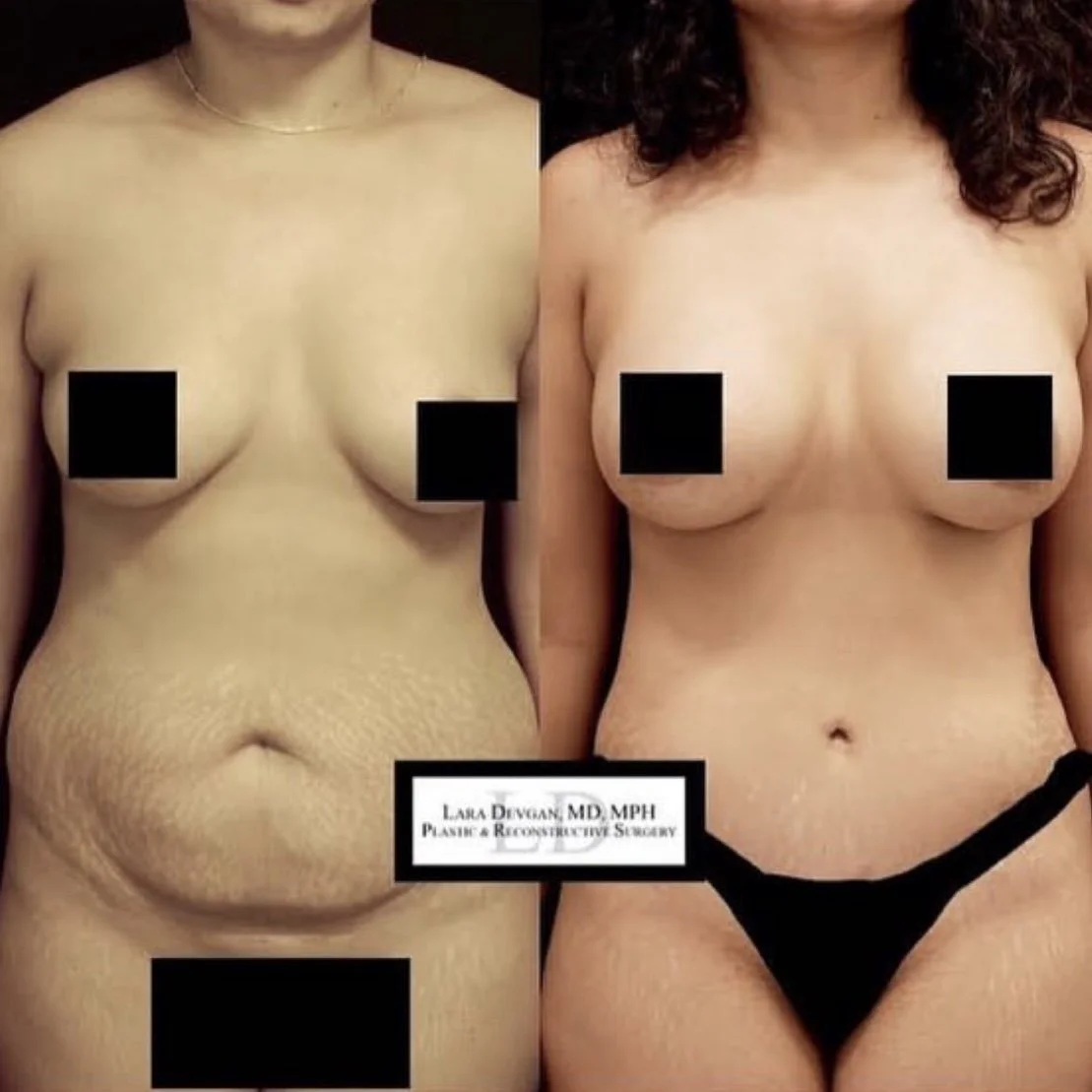  Breast Augmentation with Internal Lift, Abdominoplasty, &amp; Liposuction: Before &amp; After | Center 