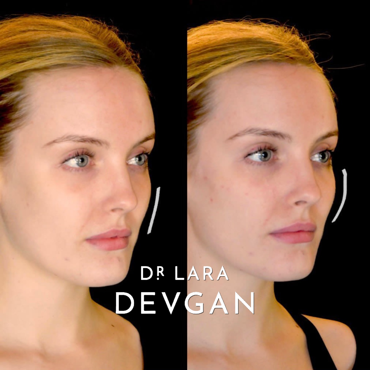 Devgan_SP_B&A_Cheeks_WM_Photo1_1.0.png