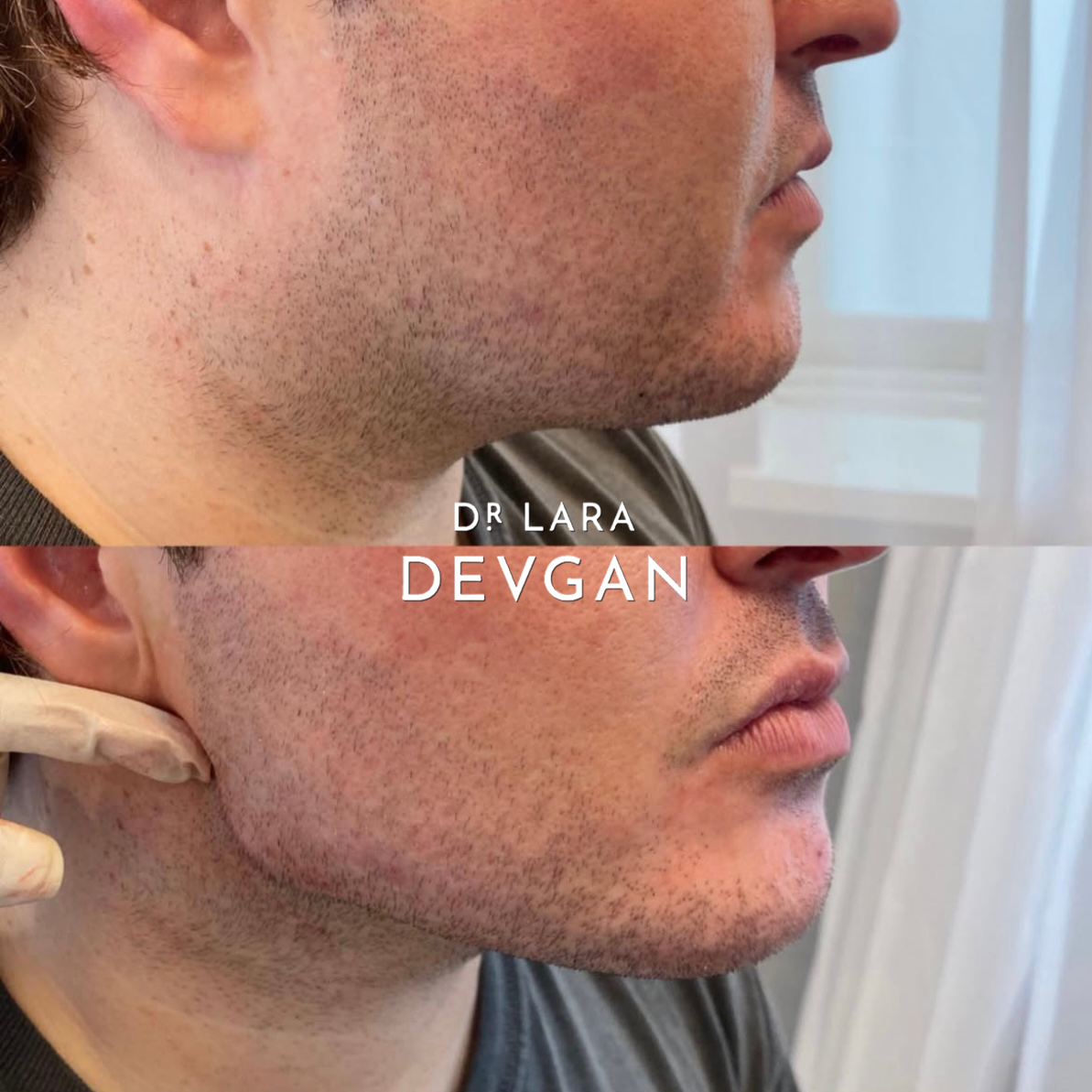Devgan_SP_B&A_Jaw_WM_Photo1_1.0.png