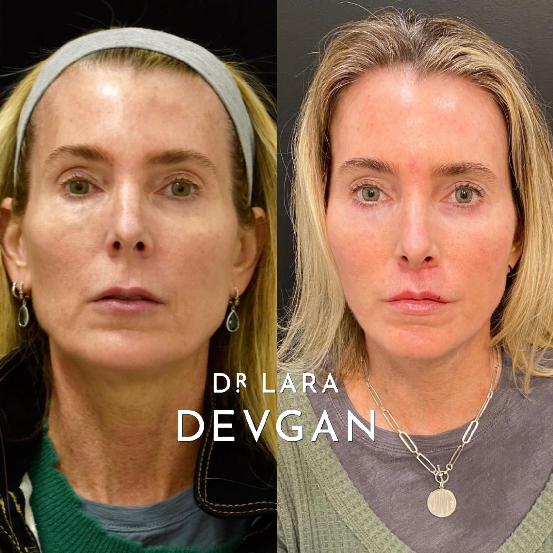 Devgan_SP_B&A_Face_WM_Photo18_1.0.png