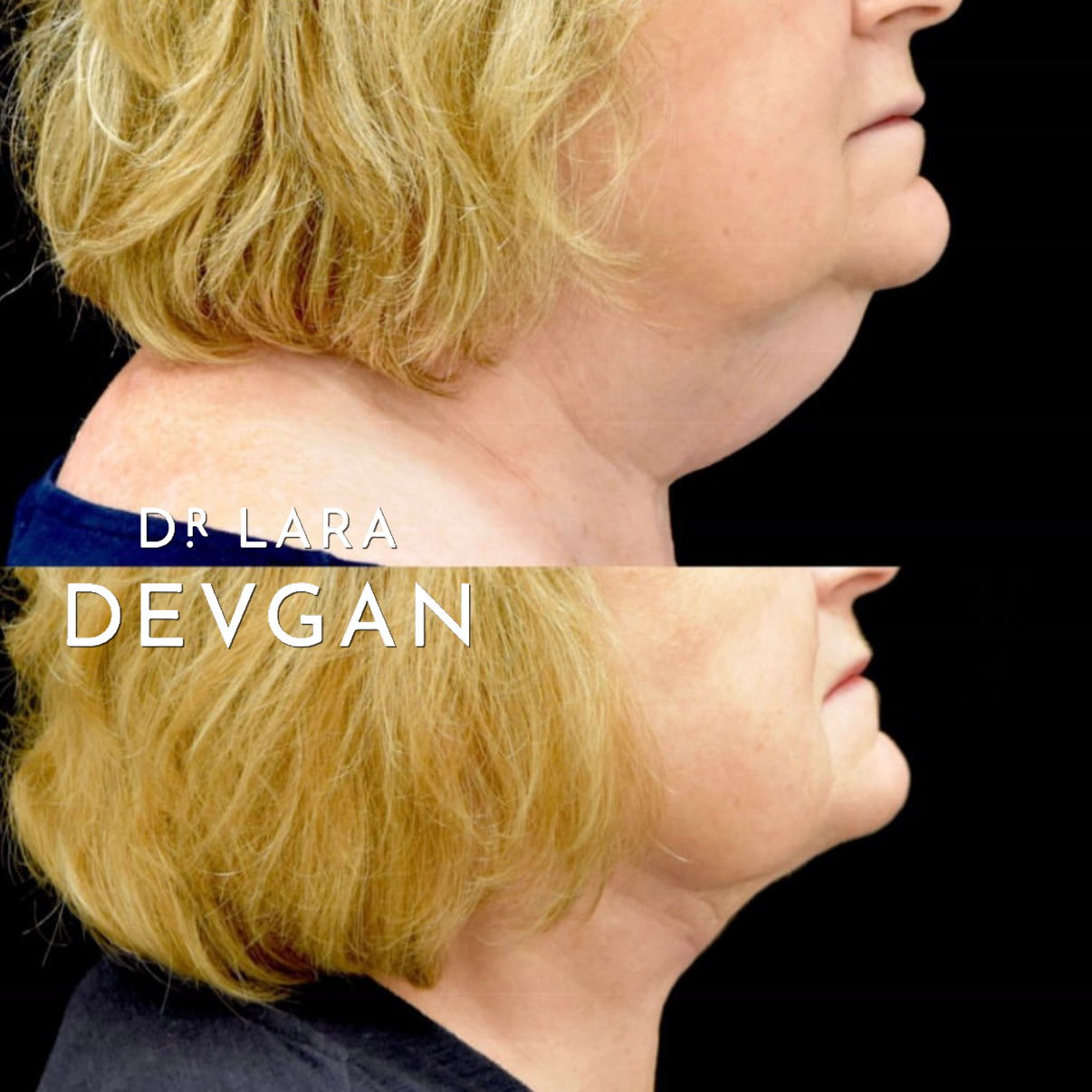 Devgan_SP_B&A_Neck_WM_Photo1_1.0.png