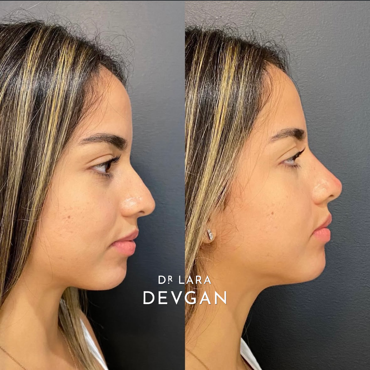Devgan_SP_B&A_Nose_WM_Photo2_1.0.png
