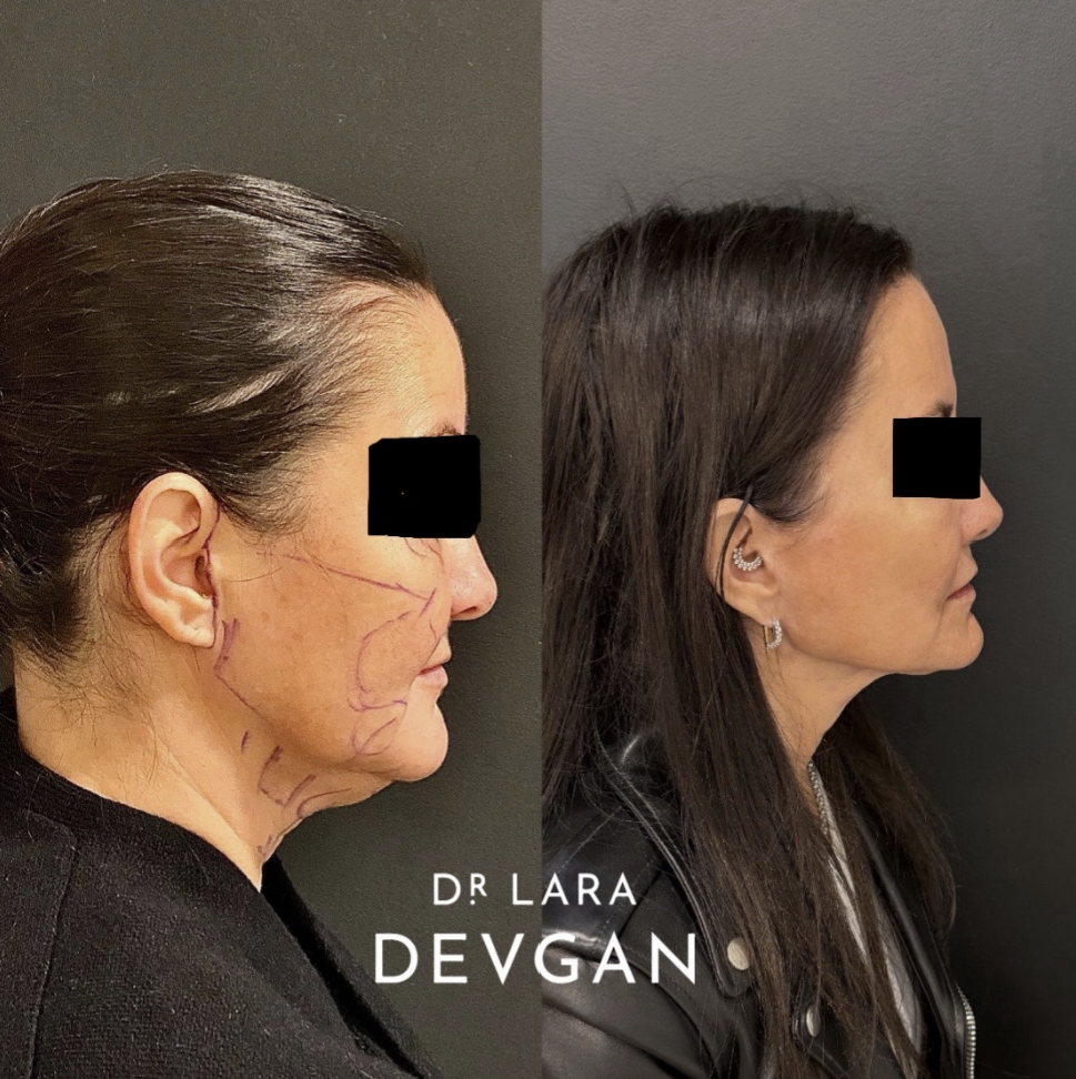 New York City Best Facial Plastic Surgeon