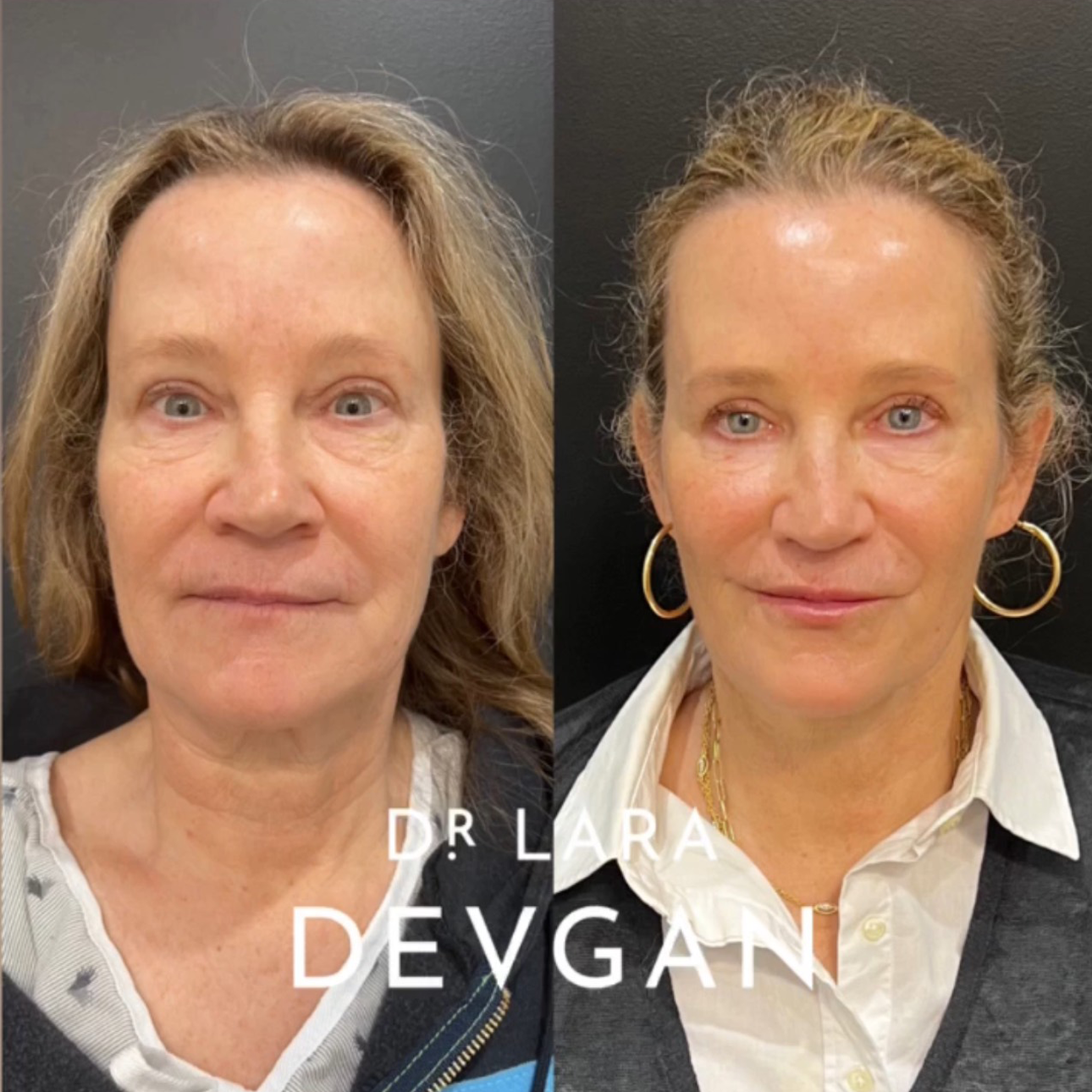 NYC Plastic Surgeon Facelift