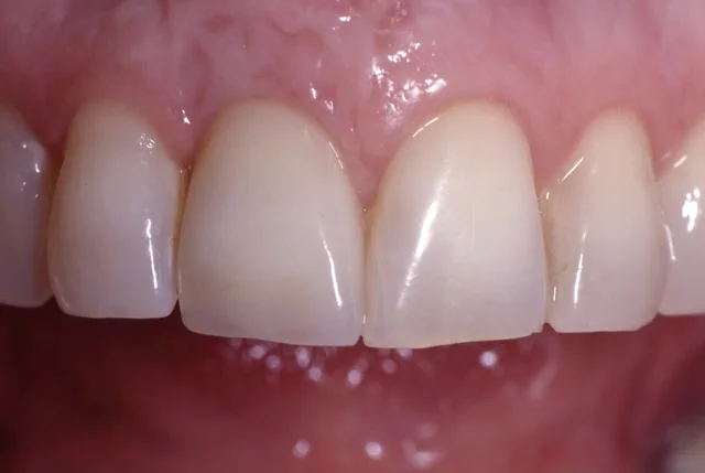 Patient 2: (After) Dental Implant and Crown on Right Central Incisor