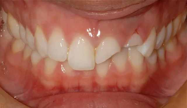 Patient 1: (Before): Fractured Central and Lateral Incisor