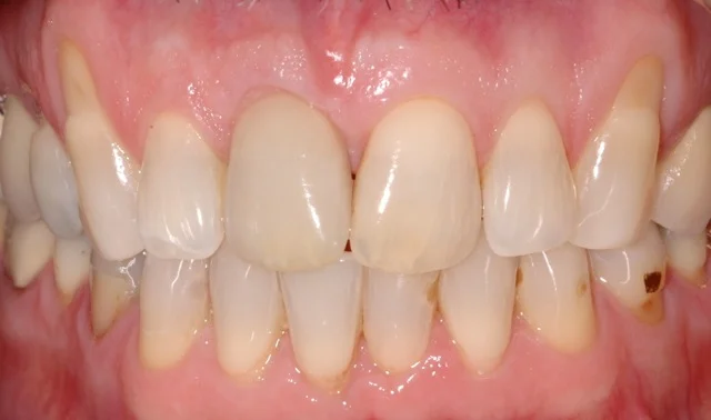 Patient 3: (After) Dental implant and Crown Replacing Right Central Incisor