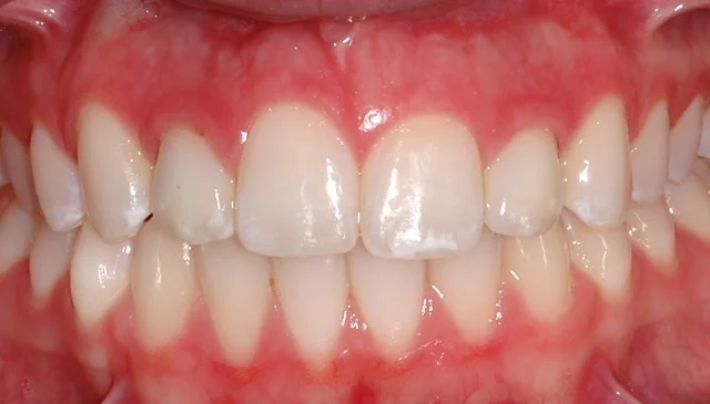 Patient 4: (After) Dental Implants and Crowns to replace congenitally missing Lateral Incisors