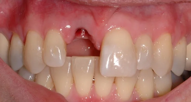 Patient 6: (Before) Missing right Central Incisor