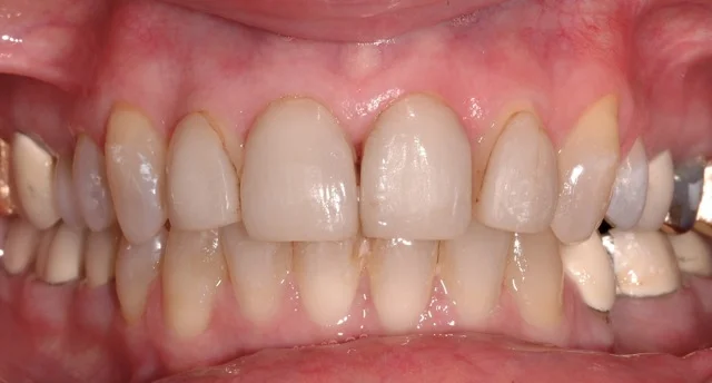 Patient 8: (Before) Old Porcelain Veneers
