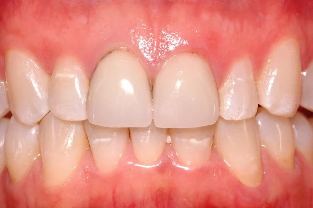 Patient 9: (Before) Old Porcelain Veneers on both Central Incisors