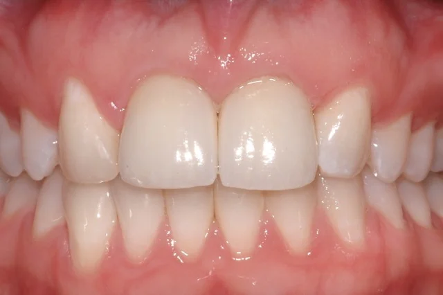 Patient 11: (After) Implants and crowns replacing failed and unesthetic original crowns.