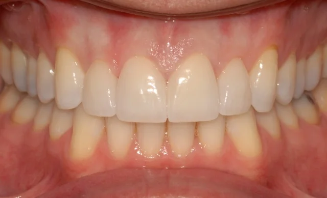 Patient 13: (After) Four Porcelain Veneers on Upper Incisors