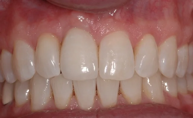 Patient 14: (after) Dental Implant and Crown to replaced failed right Central Incisor.