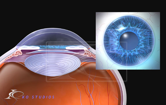 Staar® Interocular Lens (IOL)