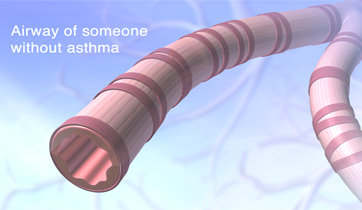  Asthma bronchioles  KO Studios ©2012, All rights retained  &nbsp; 