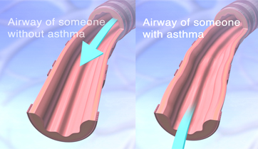  Asthma airways and normal bronchioles.   KO Studios ©2012, All rights retained  &nbsp; 