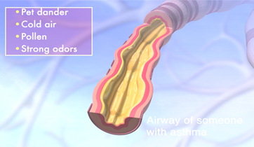  Asthma airways with mucous.&nbsp;  KO Studios ©2012, All rights retained  &nbsp; 