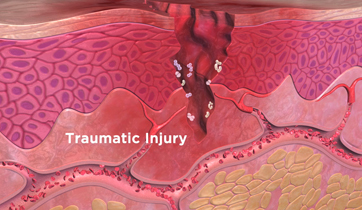  Inflammatory response to traumatic injury 