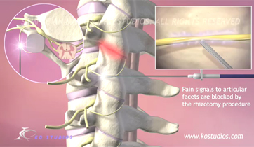  Cervical Facet Syndrome KO Studios ©2013 All Rights Reserved 