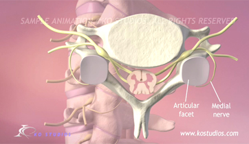  Cervical Facet Syndrome KO Studios ©2013 All Rights Reserved 