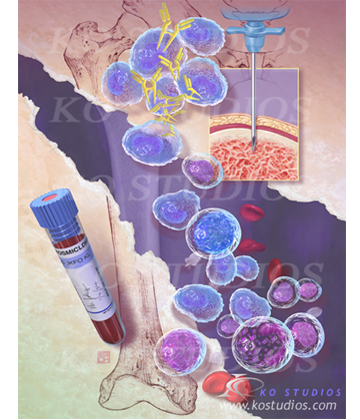 Hematological Malignancies