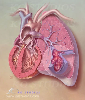 Pulmonary Embolism in Lung with Heart