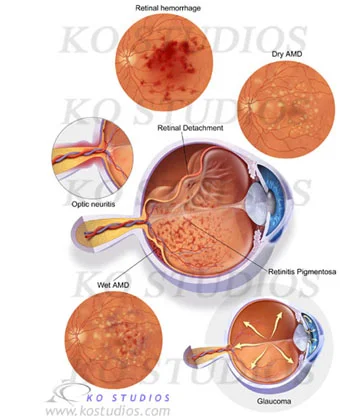Eye Pathologies