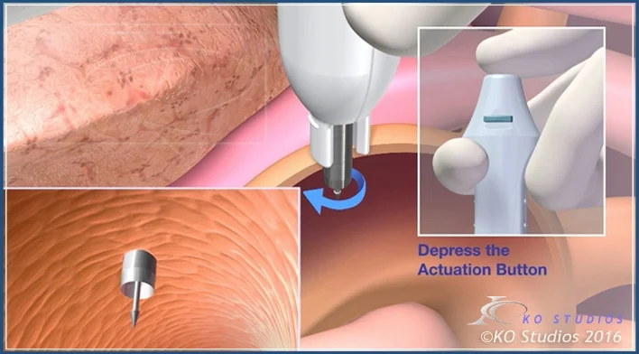 Proximal Anastomotic Device 3D Animation - RX Club 2017