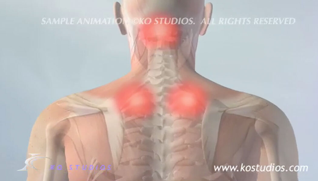 KO Studios Medical Legal Stock images and Animations — KO Studios  Biomedical Animation and Illustration