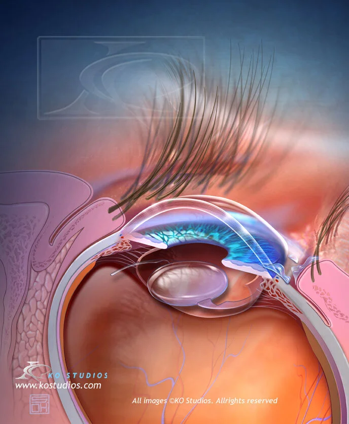 Cataract Surgery 4
