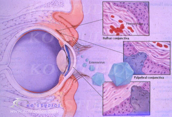 Conjunctivitis