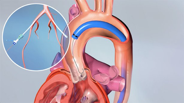 Encompass TAVR 3.jpg